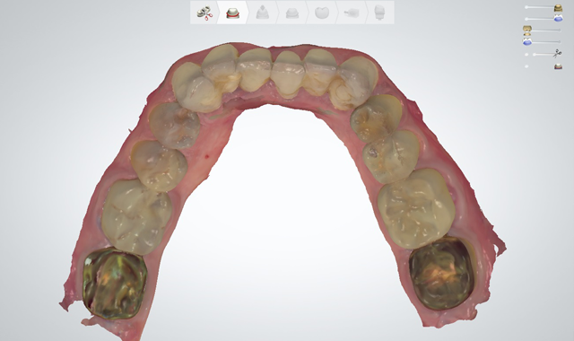 Occlusal view of the mandibular provisional restoration digital scan