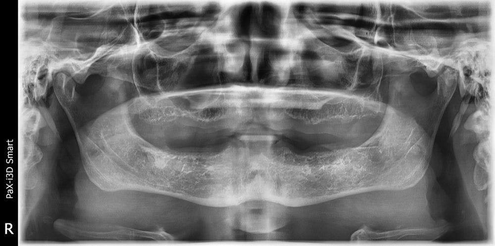 Author’s first case­—a lady who hated her dentures and was willing to pay big for something fixed. At the time, Dr Gupta didn’t have a CBCT, but he had faith in his ability to place the implants where they belonged, based solely on the pan. Somehow, the maxillary sinus, especially on the right side, didn’t phase him, though he says now that it should have (Figure 1).