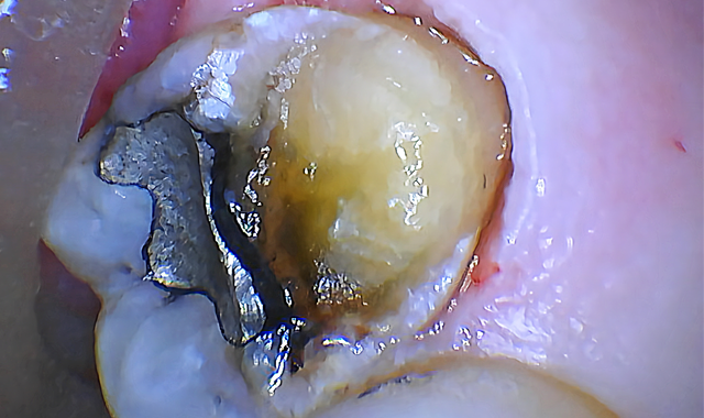 Figure 4 Osseous Tissue Removed
