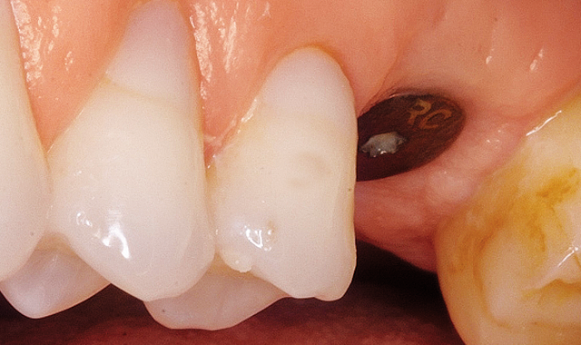 ntegrated implant with healing cap at tooth #14
