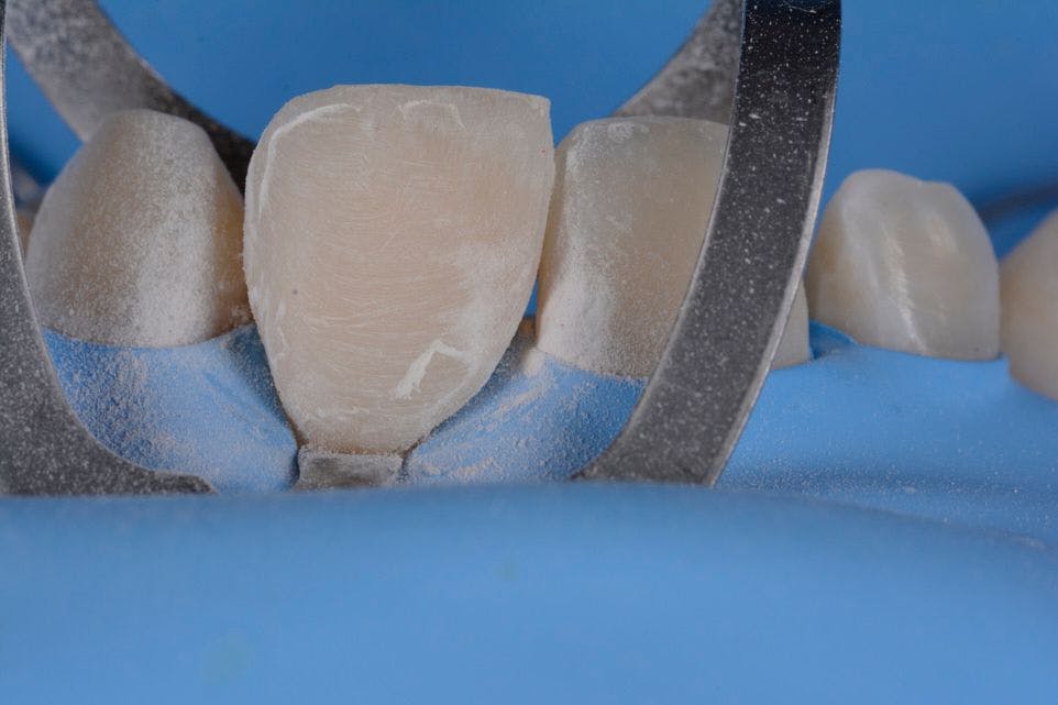 How to Achieve Esthetic Outcomes by Using Single-Shade Composites