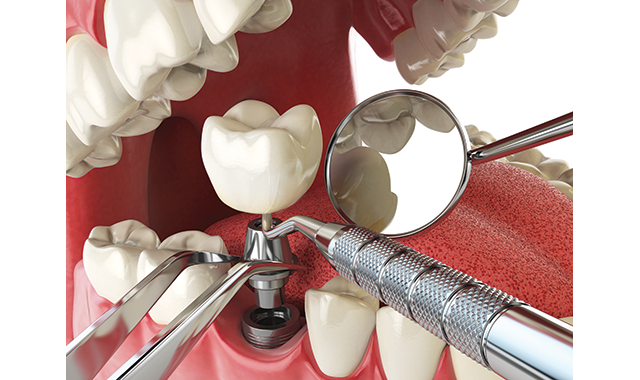6 mistakes dentists make placing implants