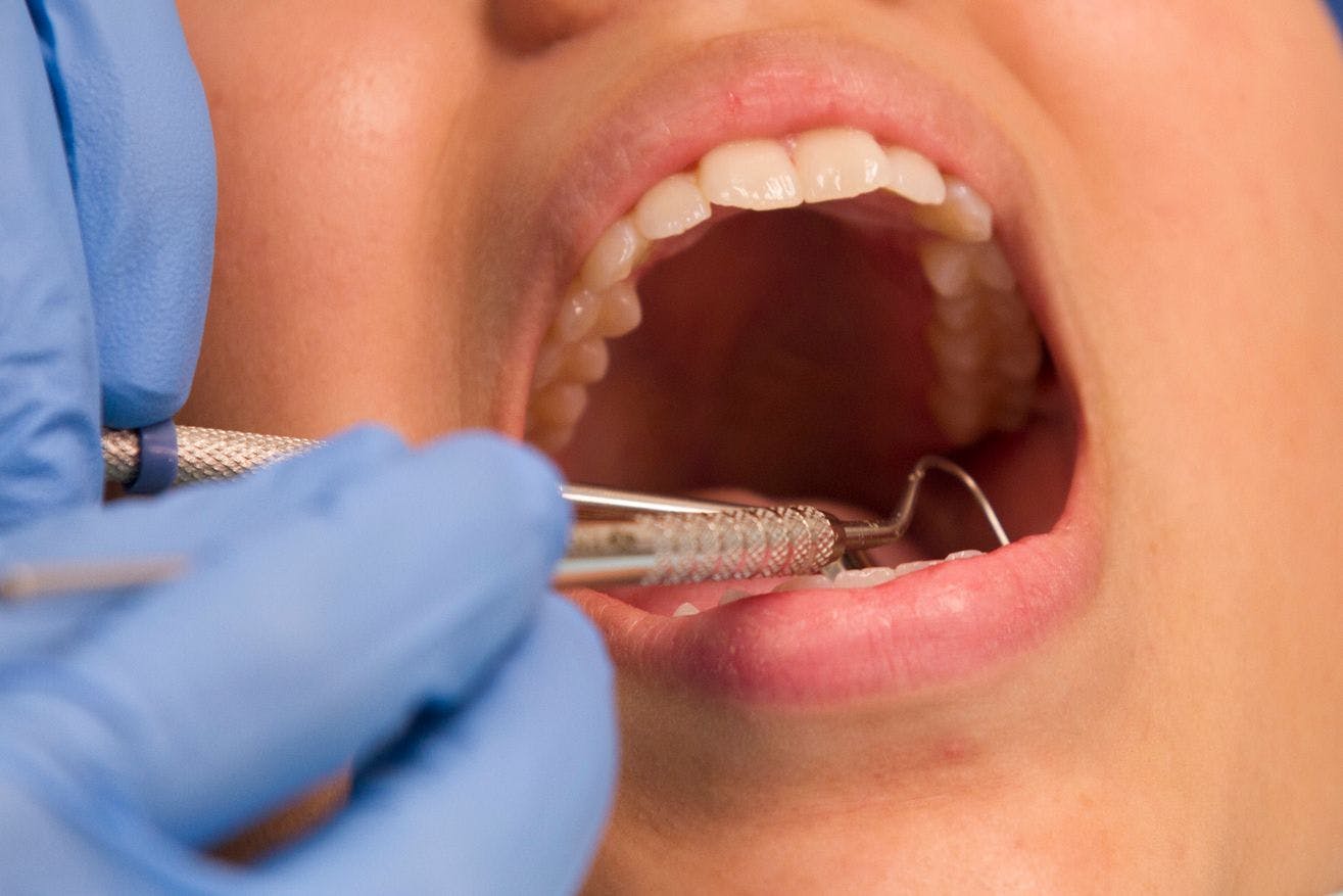Good Dental Health Linked to Heart Infection Prevention and Decreased Antibiotic Overuse