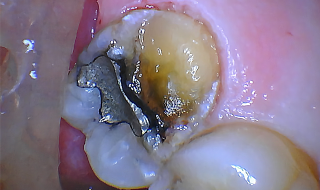 Figure 3 gingiva removed