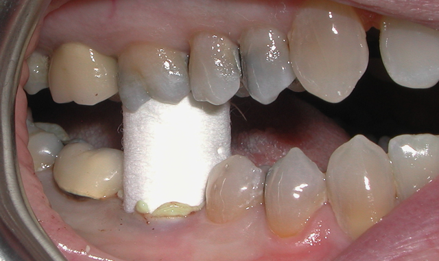 Fig. 11Patient bites firmly on a Retraction Cap (Premier Dental) for at least two minutes