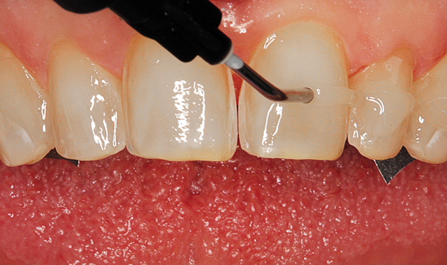 Calibra luting composite syringed onto tooth surfaces