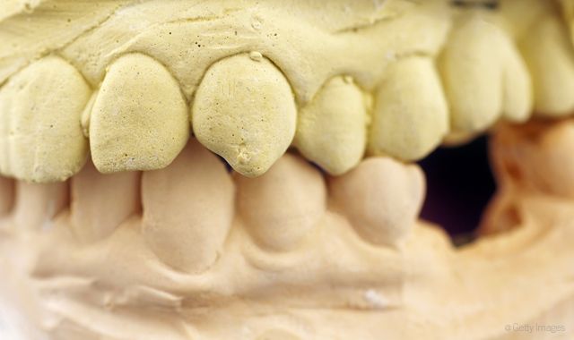 New study finds troubling rates of dental implant complications
