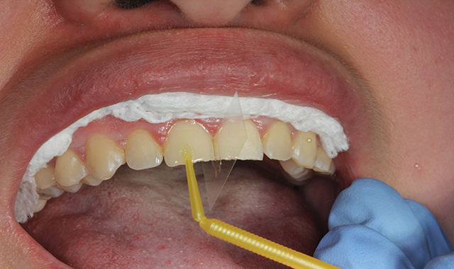 Adhesion Dentistry 101