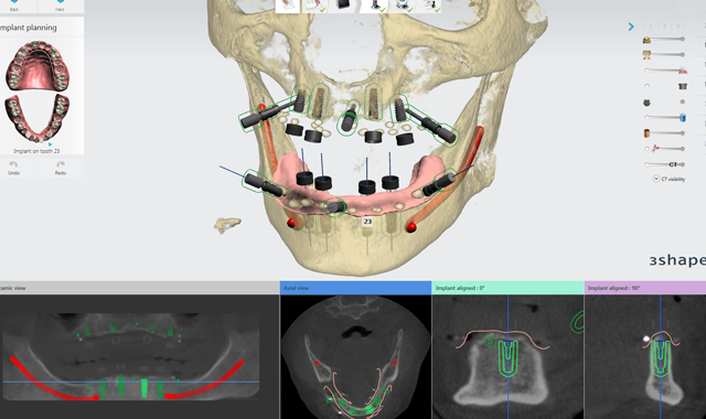 Model of the patient with implant locations.