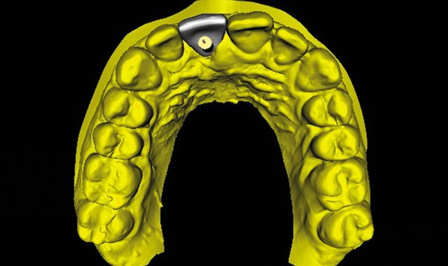 Implant position to allow for screw-retained temporary and eventual final restoration.