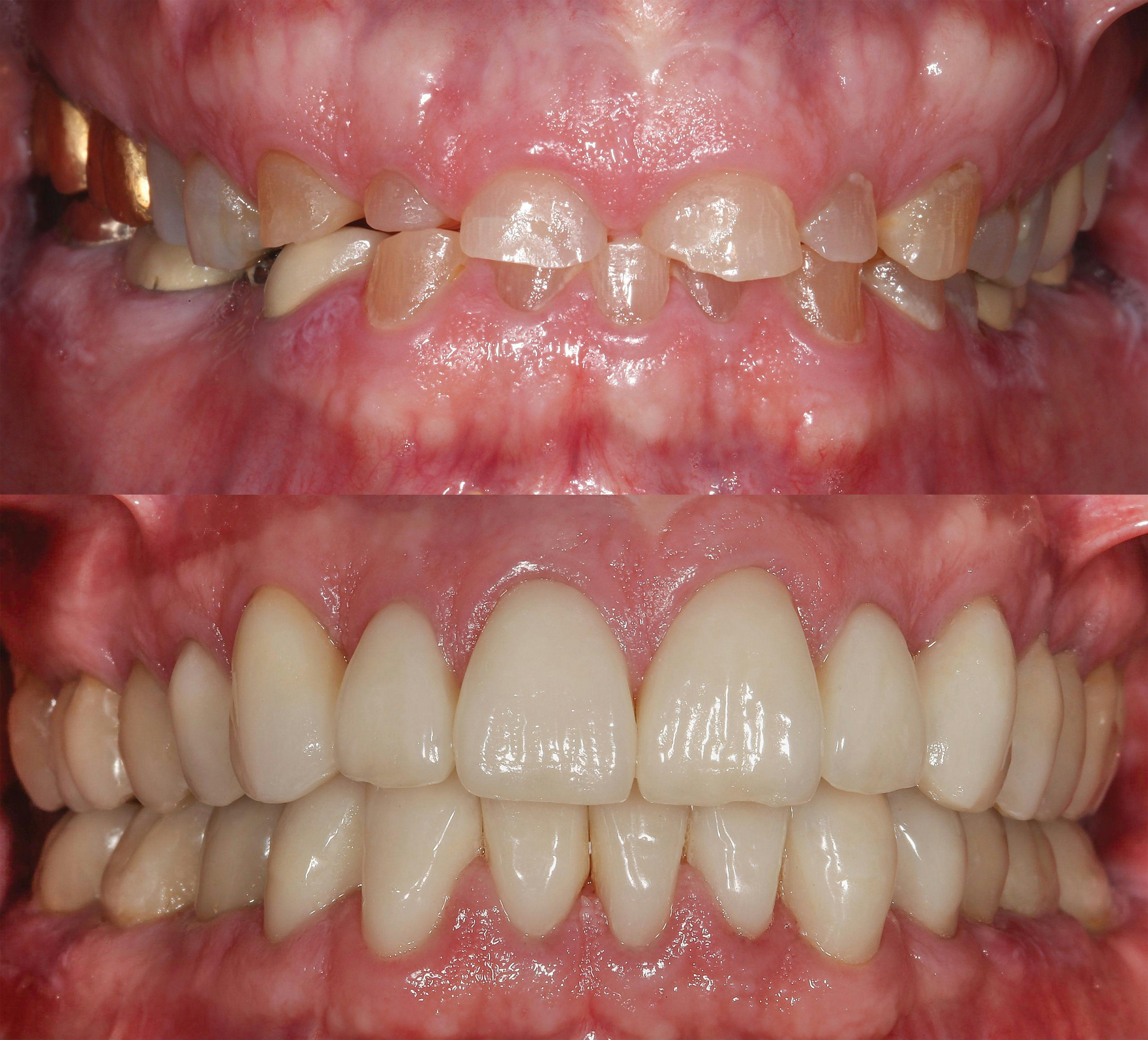 Full mouth reconstruction with IPS e.max from Ivoclar Vivadent
