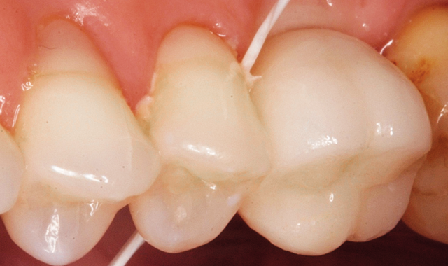 Floss removes excess interproximal cement