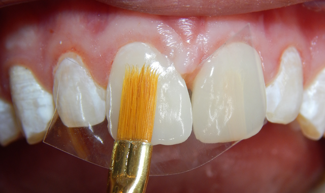 How to achieve esthetic restorations for the pediatric dental patient