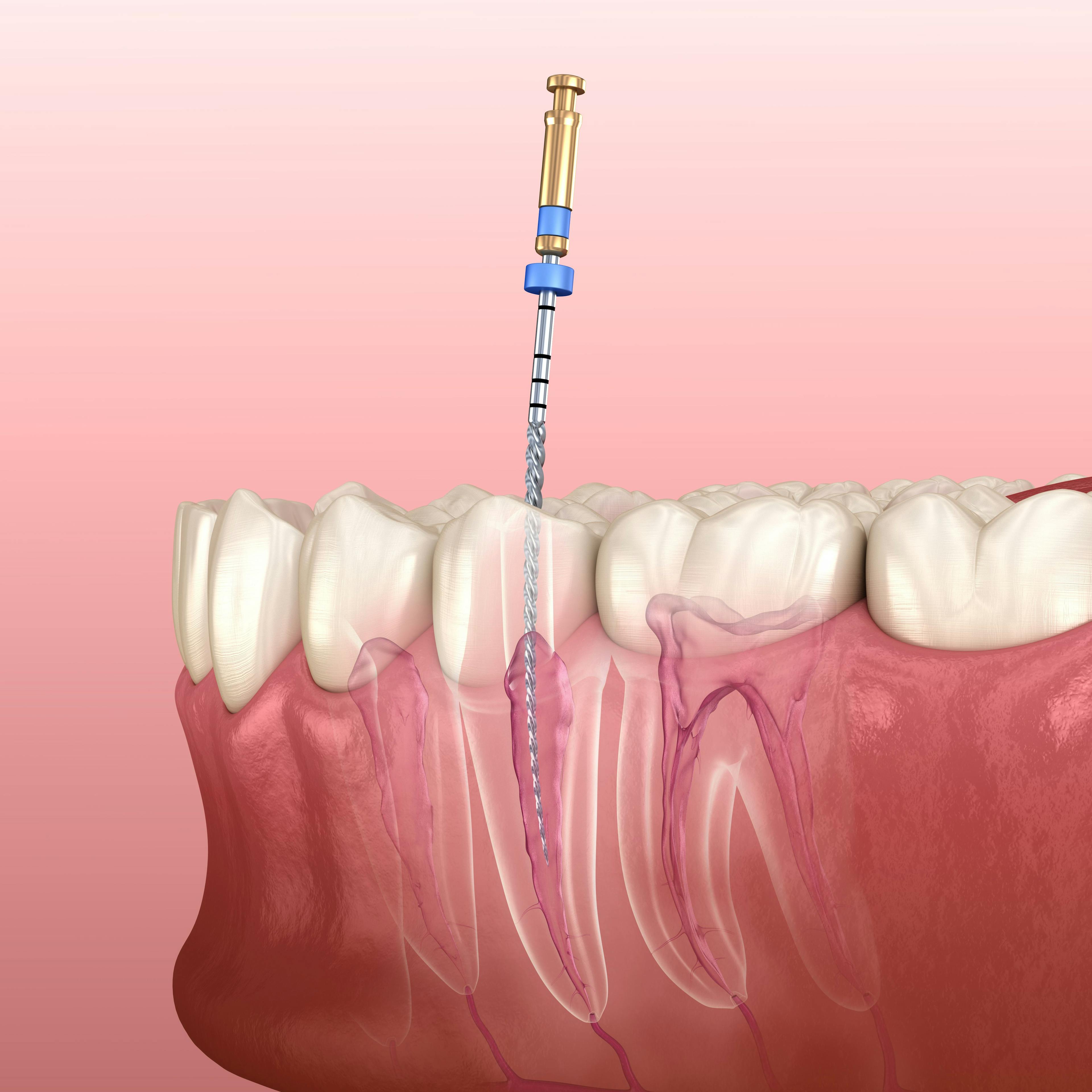 A visualization of an endodontic root canal procedure in the oral environment