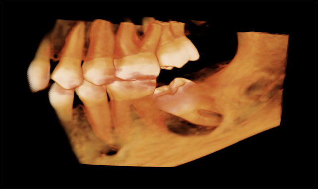 How CBCT benefits both you and your patients