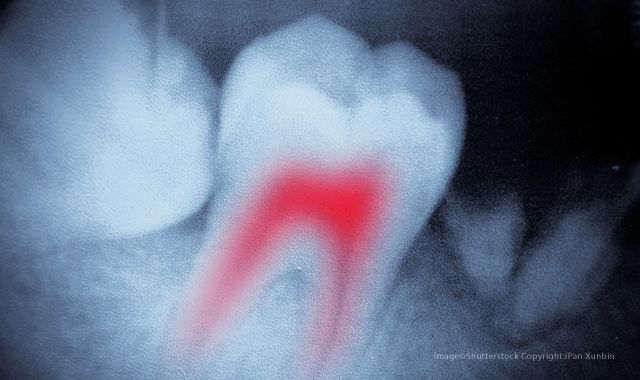 New discovery could eliminate infections after root canals