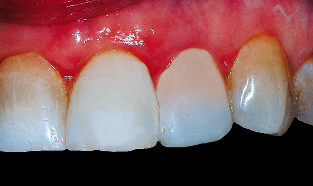 Final direct composite veneer built out to the facial contour of the adjacent teeth to improve the esthetics. 
