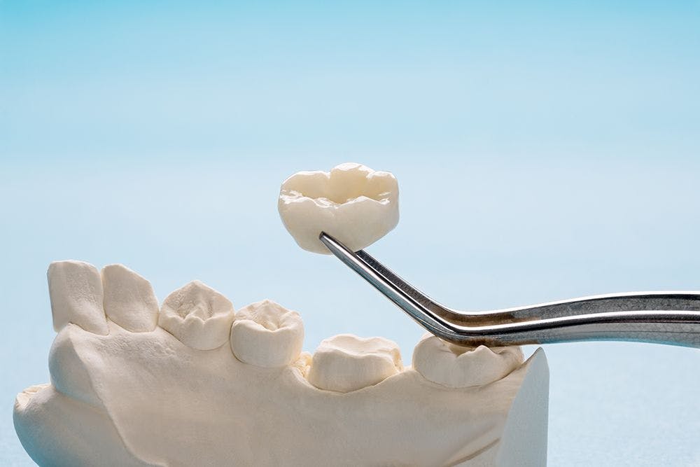 Why You Should Bond to Zirconia Instead of Cement