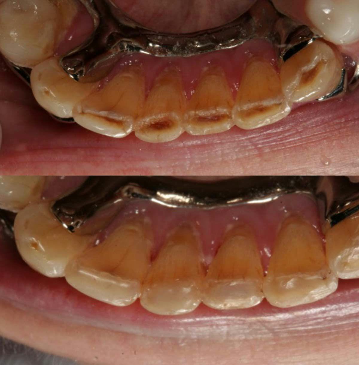 The before and after clinical photos courtesy of Tony Tomaro, DDS,Chicago, Illinois.