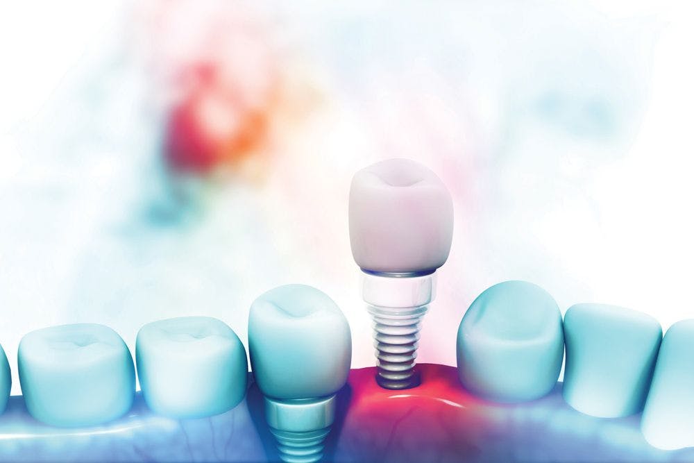 Dental Implants Emerge as Industry's Next Anchor