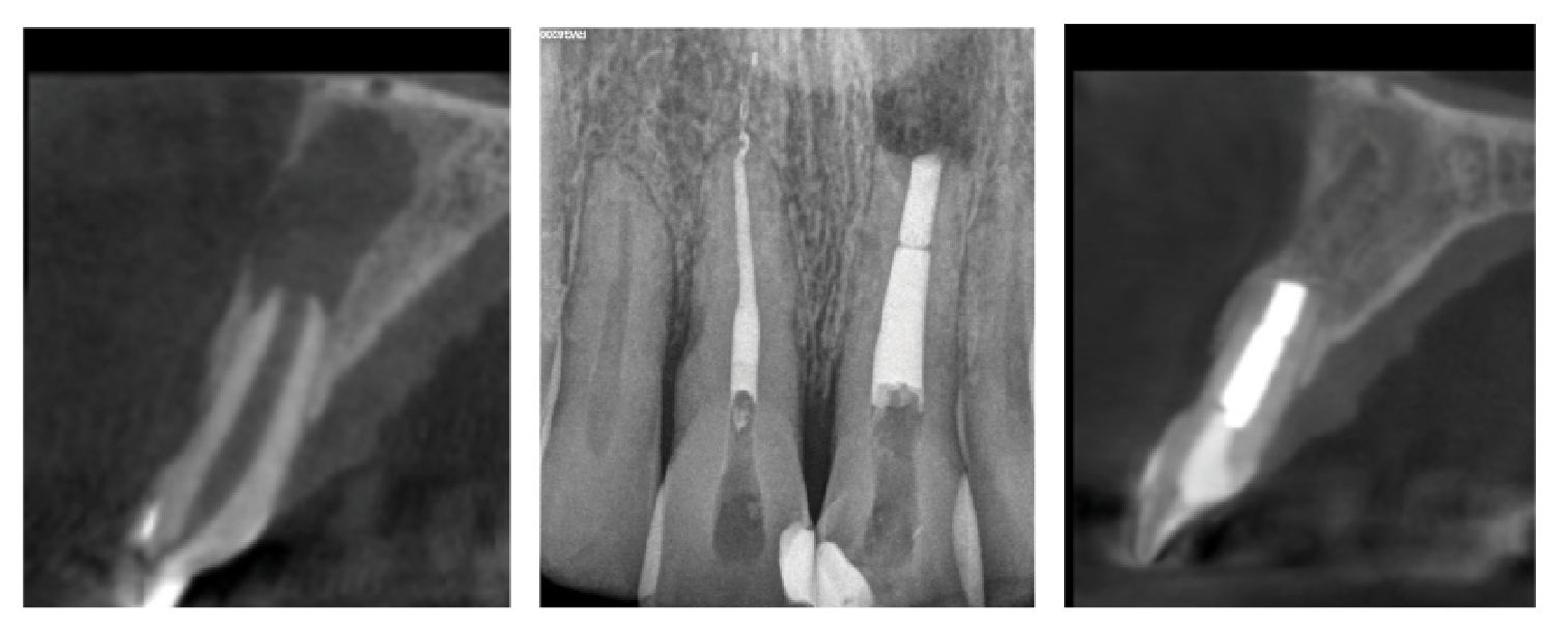 Figure 6. Apical microsurgery, using modern technologies including magnification, ultrasonic root preparation, and bioceramic-based root filling materials, has an excellent prognosis. This patient presented with a large lesion associated with tooth #9 on sagittal CBCT section (A), and both nonsurgical and surgical treatment were recommended and completed (B). At 1-year follow-up, complete reformation of the periodontal ligament was noted on sagittal CBCT section (C).