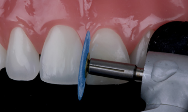 How to achieve esthetic results with direct composites