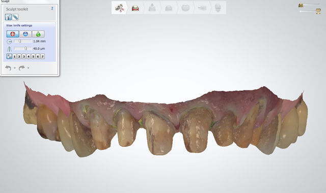 Facial view of the maxillary preparation digital scan