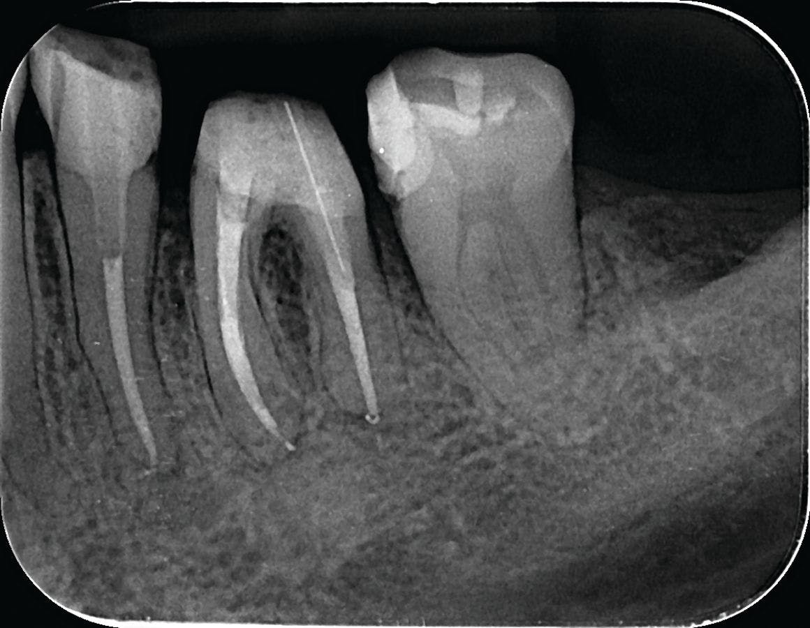 Overcoming Endodontic Hurdles with Restorative Products. Image credit: © Centrix