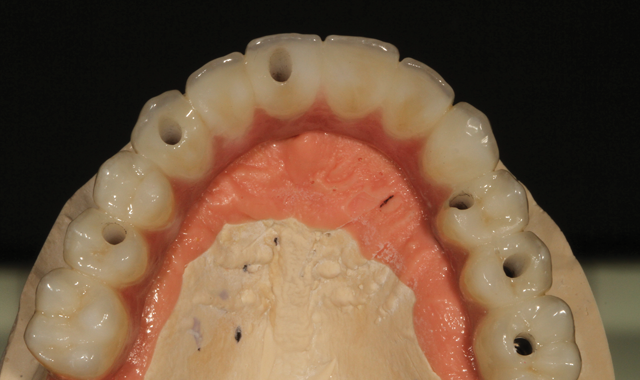 Occlusion view of dental restoration