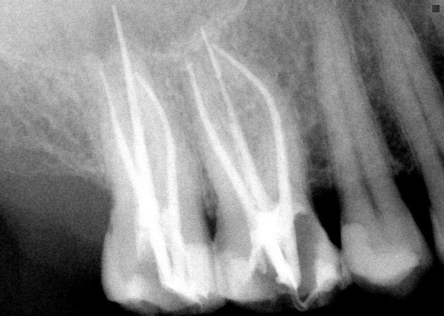 postop image of a tooth treated using Bio-C