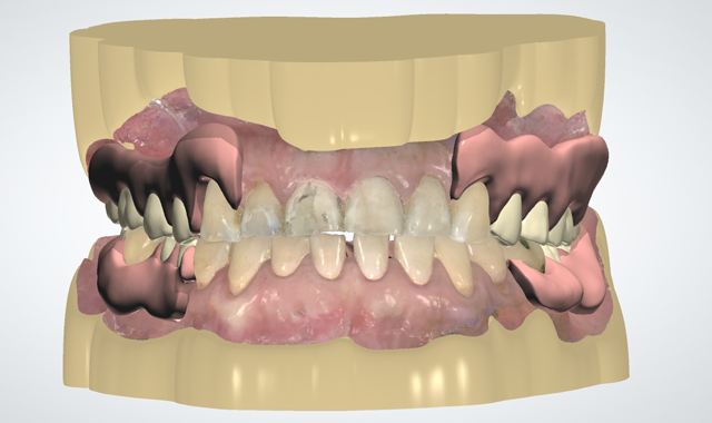 Maxillary and mandibular flexible partial dentures