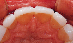 Veneers placed on teeth