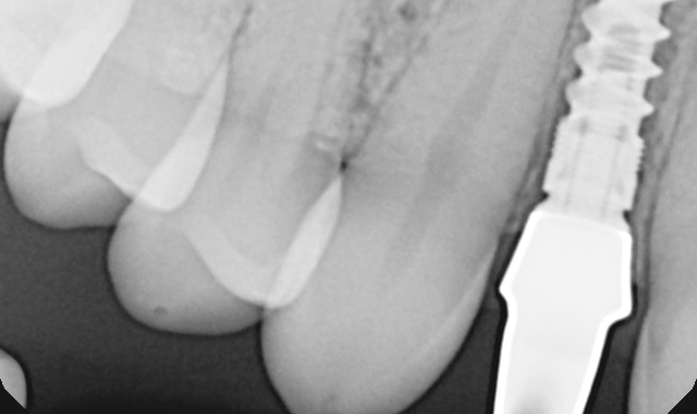 Complete seating of the custom abutment was confirmed with a periapical X-ray. 