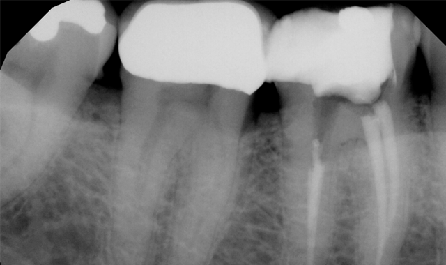 Fig. 2 Post-op radiograph of tooth #30 following root canal therapy