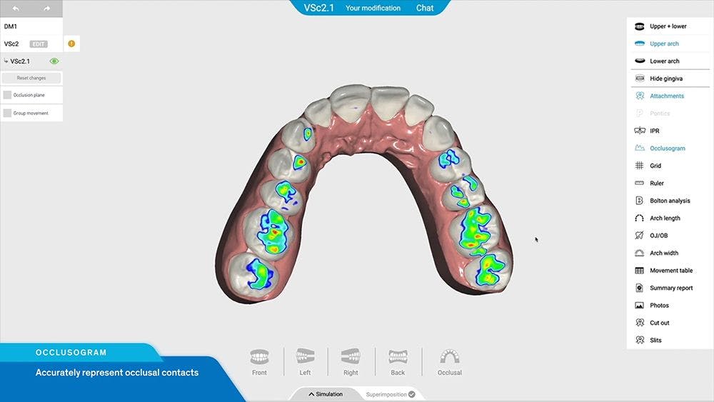 Henry Schein Orthodontics’ Offers New Treatment Planning Software For Reveal Clear Aligners