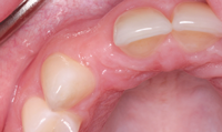 Occlusal view of edentulous area shows facial-palatal resorption of the ridge. 
