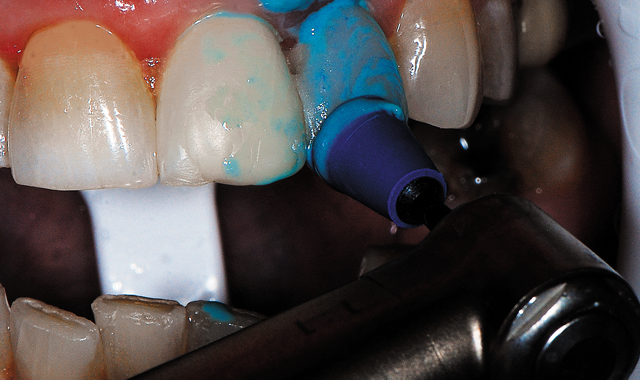 A blue ultrafine grit diamond finishing cup with diamond polishing paste (Couture, Centrix Dental) used with light pressure in an electric slow-speed handpiece without water, polishing the coronal two thirds of the restoration.