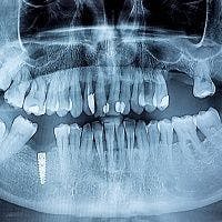 Study Suggests Bioceramics Could Fight Periodontitis