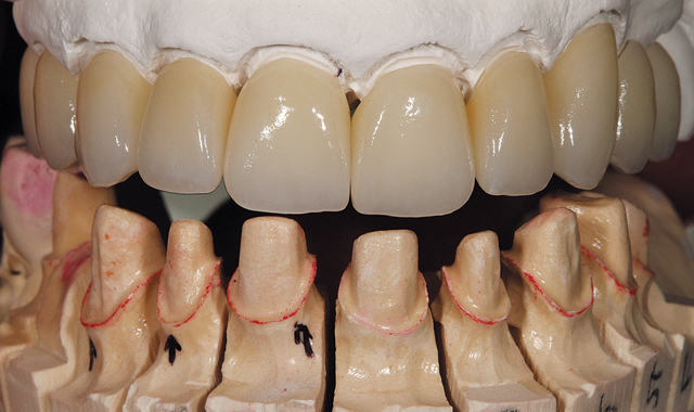 Final restorations with prepped model
