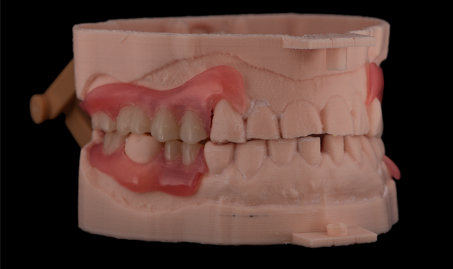Right lateral view of the completed dentures