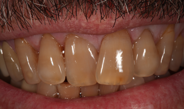 Preoperative close-up view of the patientâs natural smile