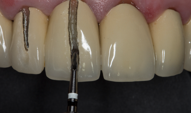 How to efficiently remove fixed restorations with crown cutters