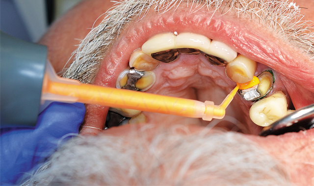How to perform tissue management for accurate crown and bridge impressions