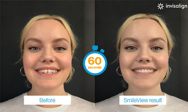 Align Technology launches SmileView