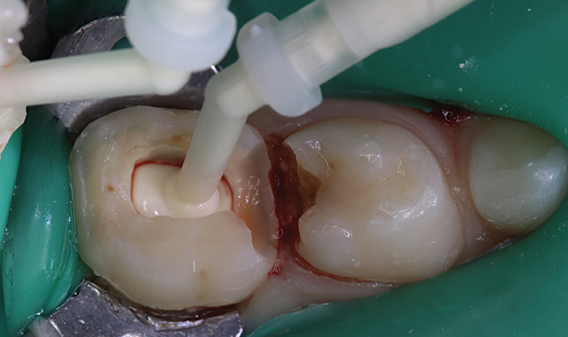 The first simple-to-place pulpotomy treatment