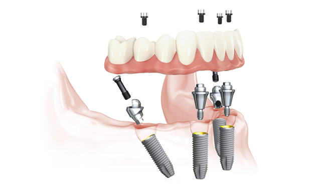Nobel Biocare unveils new solution for faster full-arch restorations
