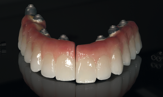 Bench mastery: Complete implant maxillary and mandibular reconstruction