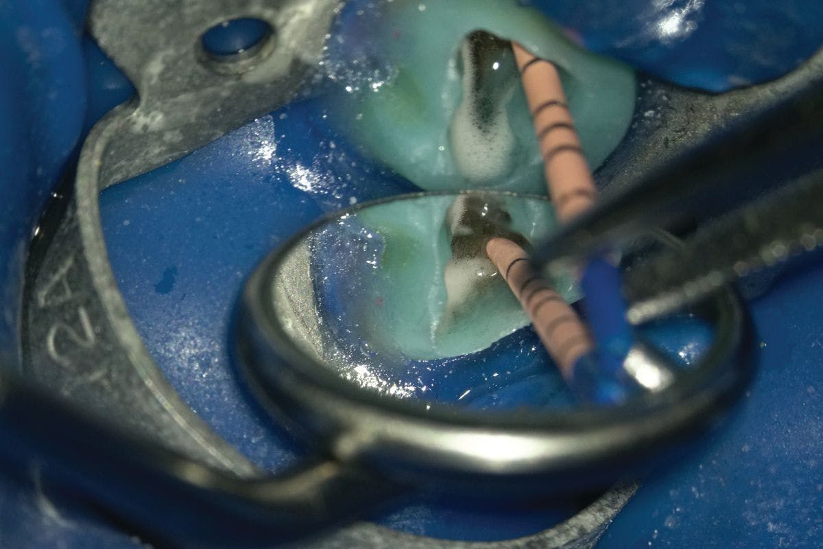 Figure 5. Rubber dam placed, Tempit removed. Continuing root canal treatment on tooth #19 with warm vertical obturation. 