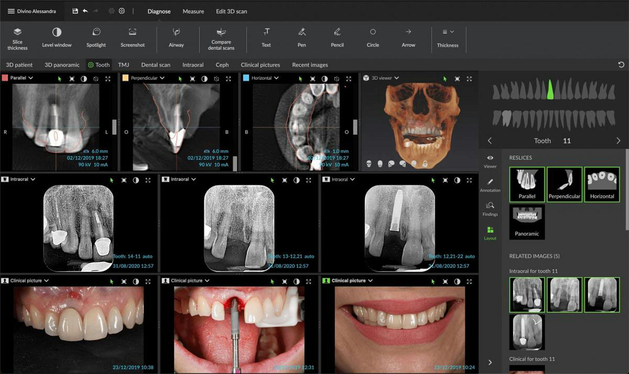 Envista Receives FDA Clearance for Assisted Intelligence Mandibular Nerve Tracing for DTX Studio Clinic