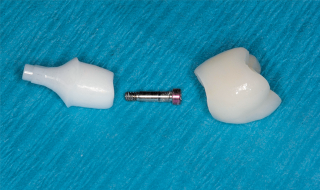 Implant abutment, retaining screw and crown ready to place